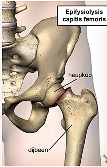 Epifysiolyse