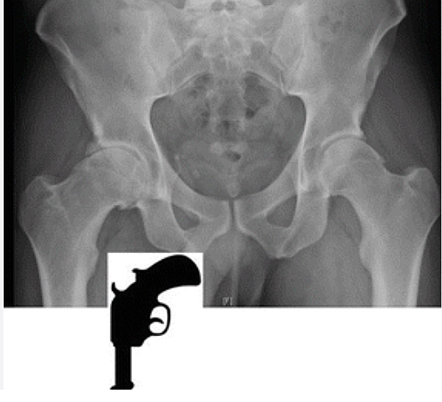 Pistol grip deformity