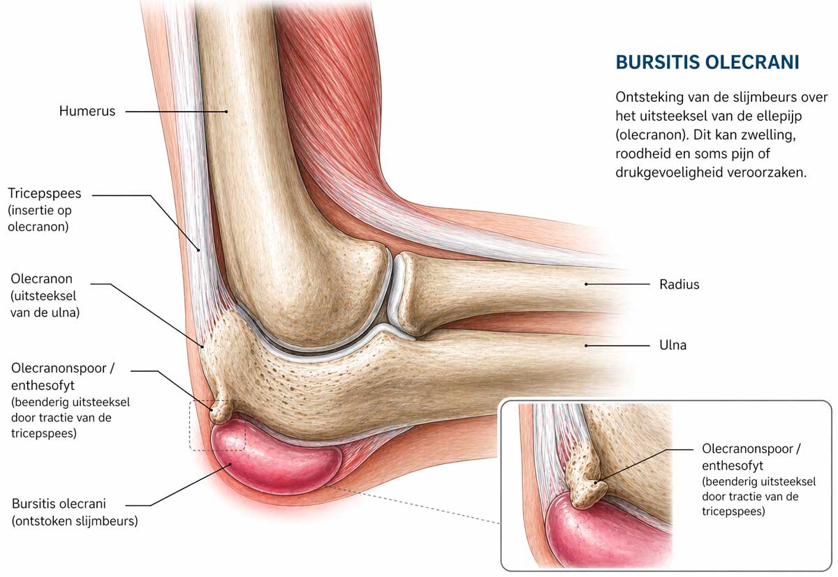 Bursitis Olecrani