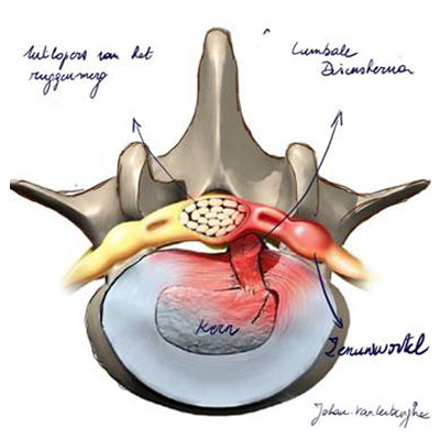 discushernia
