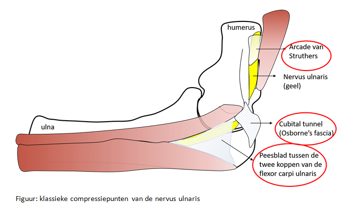 elleboog-cubital-tunnel-syndroom
