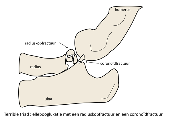 elleboogluxatie