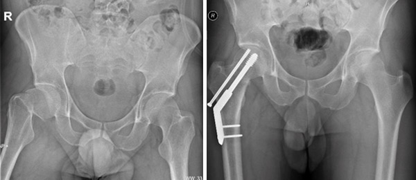 subcapitale heupfractuur osteosynthese