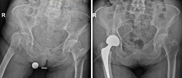 subcapitale heupfractuur prothese