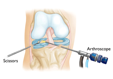 artroscopie
