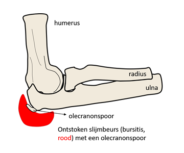 Bursitis Olecrani