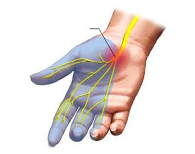 Carpal-Tunnel-Syndrome