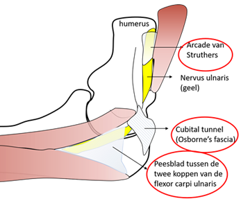 Cubital tunnel syndroom