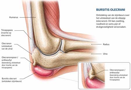 Bursitis Olecrani