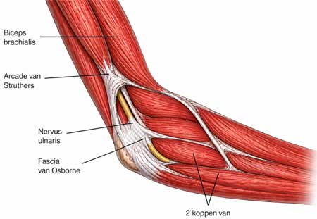 Cubital tunnel syndroom