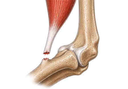 Distale bicepspeesscheur