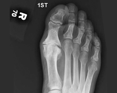 hallux rigidus