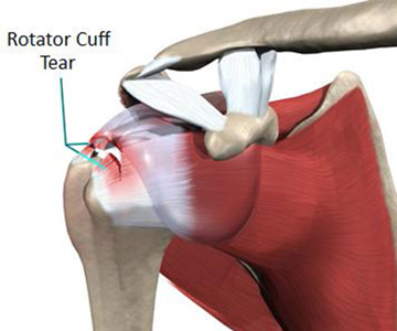 rotator-cuff