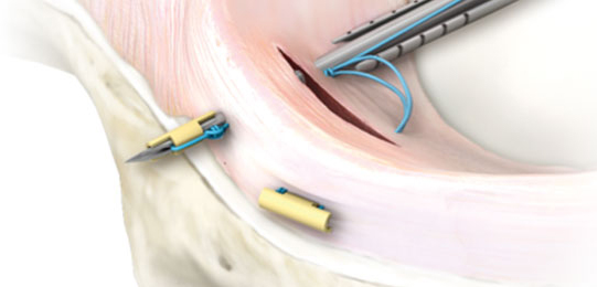 Meniscus