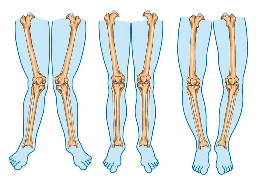 tekort Onzeker Liever Osteotomie - Orthopedie - AZ Sint-Lucas