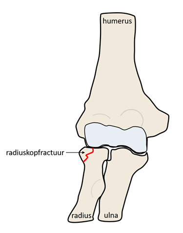 radiuskopfractuur