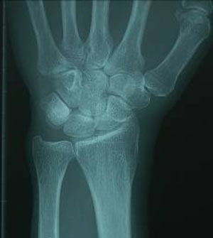 scaphoidfractuur1