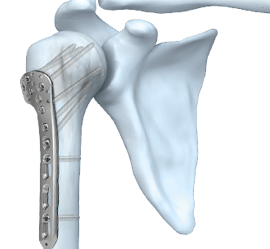 humerusfractuur