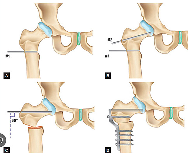 varisatie-osteotomie-heup