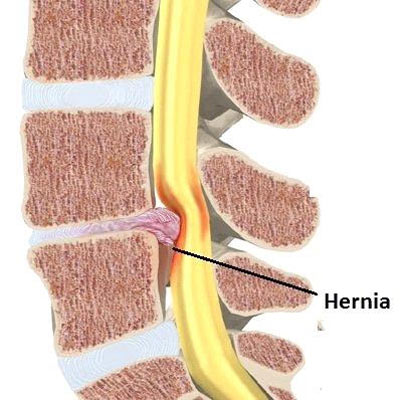 wervelkolom-hernia